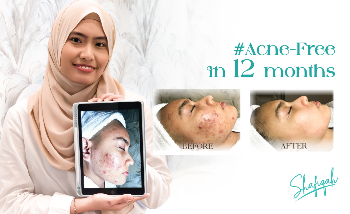 Shafiqah | Caring Skin Success Story | Acne-Free in 12 Months