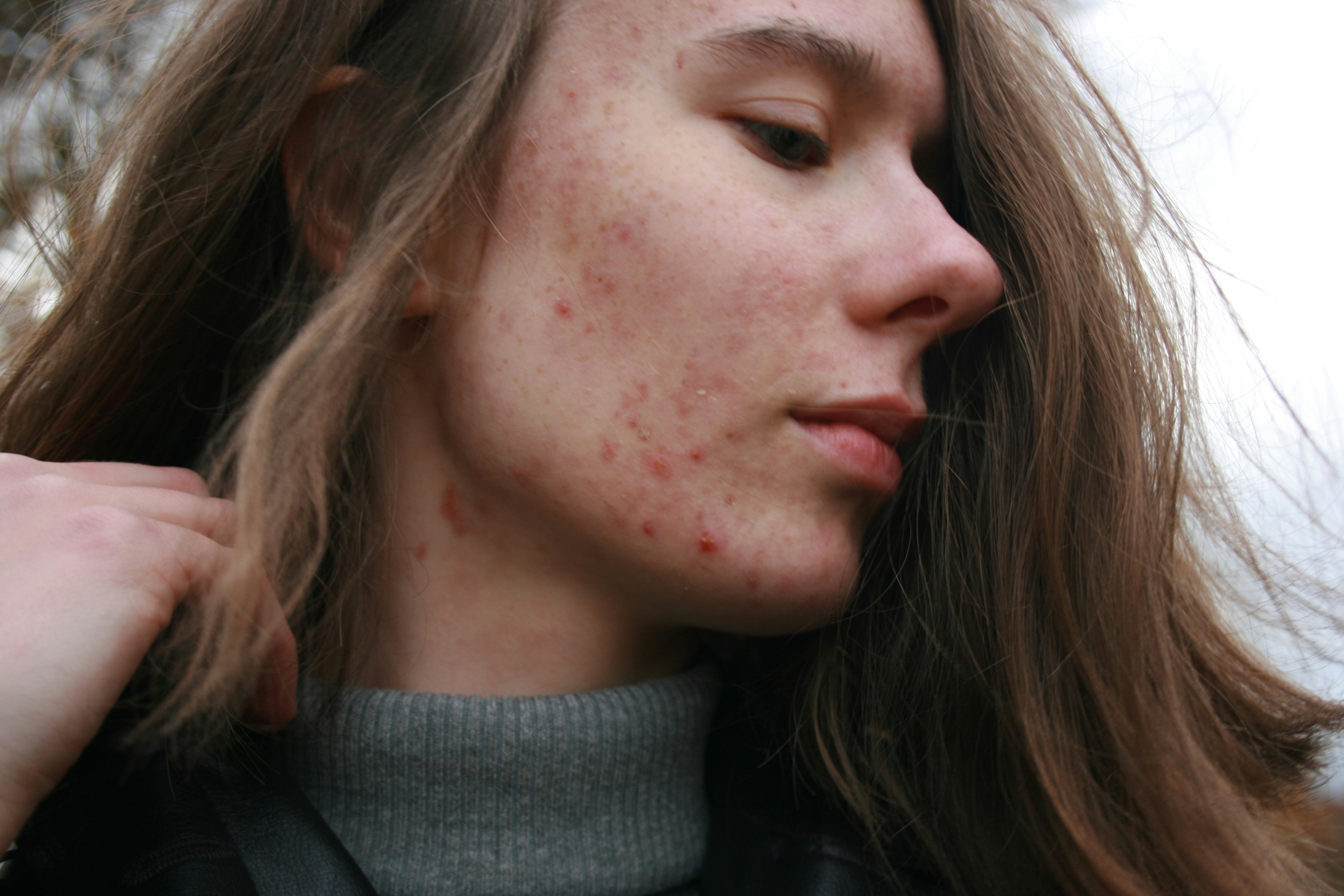 The Expert Guide to Acne and Acne Scars