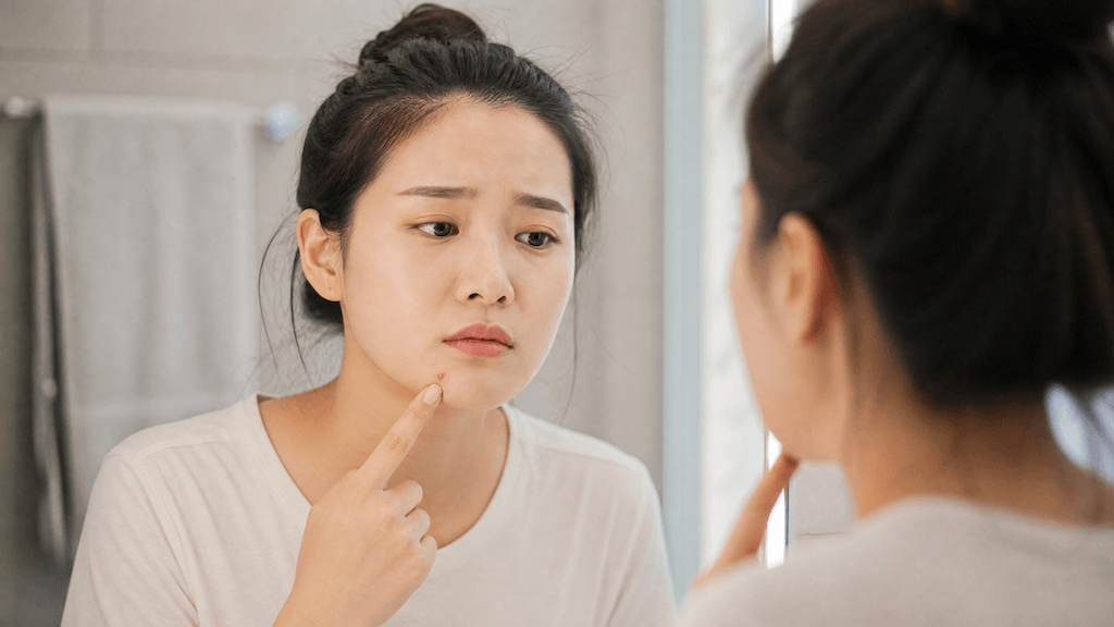 How to Get Rid of Under-the-Skin Pimples: Causes, Treatments, and Prevention Tips
